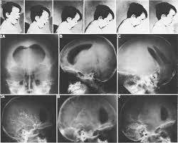 Hình chụp cắt lớp não bộ của bệnh nhi bị hội chứng đầu búp bê.